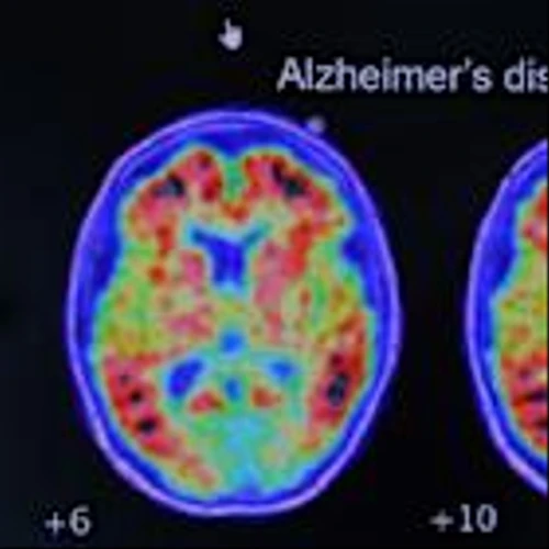 Cassava Sciences must face malicious prosecution lawsuit over Alzheimer's drug